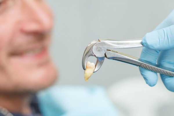 Tooth extraction at Marsh Creek Dental in Brentwood, CA